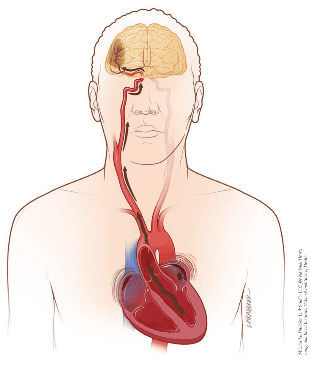 Why is AFib a Problem? – PCNA Atrial Fibrillation