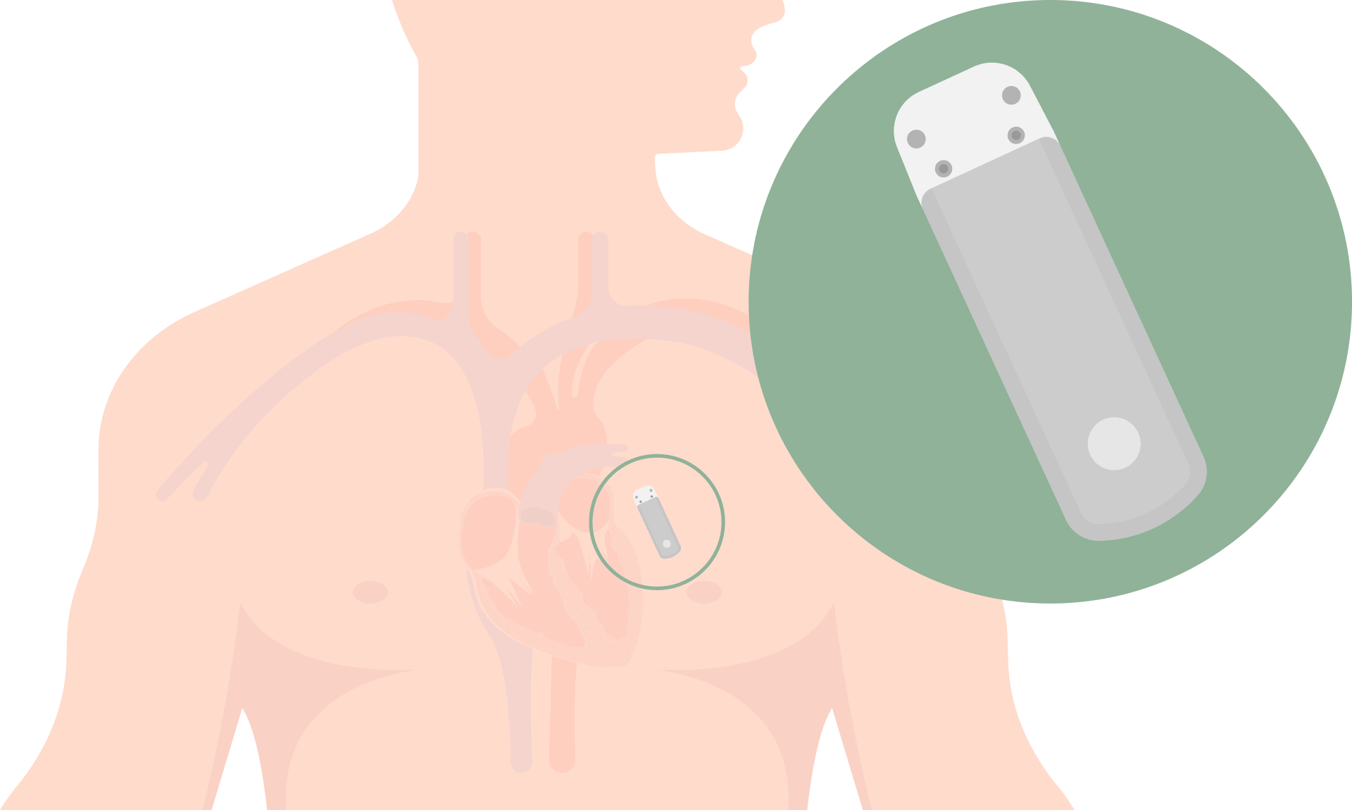 Loop Cardiaco Tratamientos y estrategias – PCNA Atrial Fibrillation